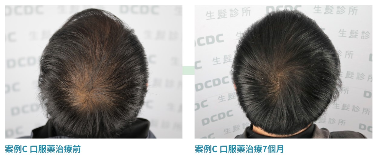 DCDC植髮診所專業雄性禿口服藥治療案例C